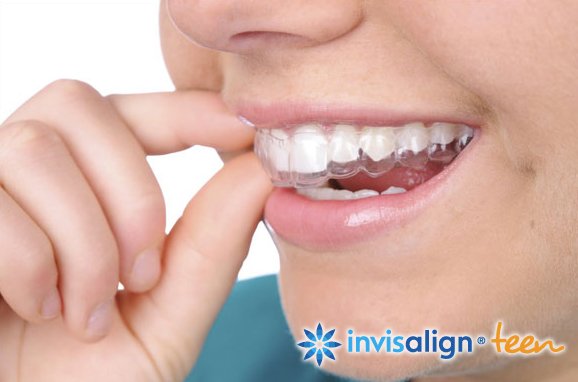 ortodoncia invisible invisalign