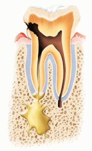 causas absceso dental