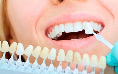 Qué son las carillas dentales y tipos